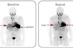 I-124 evuzamitide PET/CT images of a patient with light-chain amyloidosis showing a decrease in amyloid load and organ volume on follow-up.
