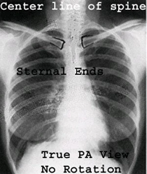 Good positioning is key to PA chest x-ray exams | AuntMinnie