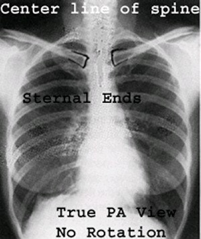 PA view without rotation. Image courtesy of Dr. Naveed Ahmad.