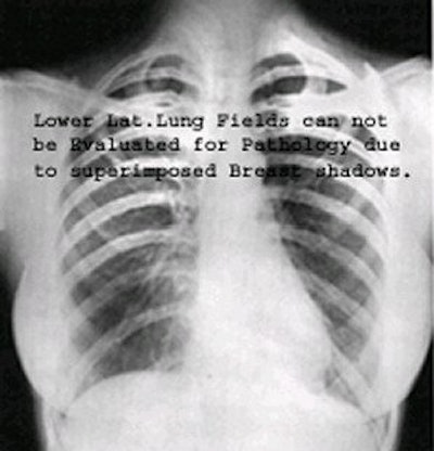 Breast shadows over lower lung fields. Image courtesy of Dr. Naveed Ahmad.