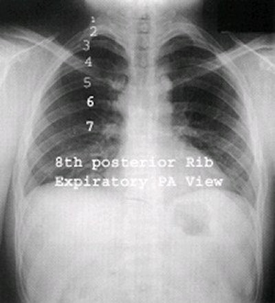 Expiration PA view. Image courtesy of Dr. Naveed Ahmad.