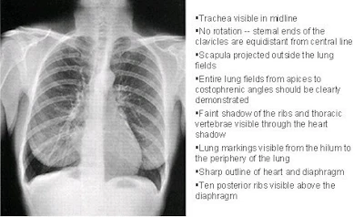 Pa Projection Program Good positioning is key to PA chest x-ray exams | AuntMinnie
