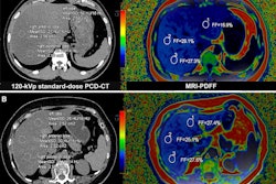 Liver fat content measurement with photon-counting CT and MRI-based proton density fat fraction (PDFF). Three regions of interest (circles) were delineated in the peripheral areas of the left, right anterior, and right posterior lobes of the liver. (A) Representative axial unenhanced 120-kVp standard-dose CT image (left) and corresponding MRI scan (right) in a 33-year-old man (body mass index, 26.2) diagnosed with metabolic dysfunction-associated steatotic liver disease (MASLD) in the asymptomatic cohort. (B) Representative axial unenhanced 120-kVp low-dose CT image (left) and corresponding MRI scan (right) in a 69-year-old woman (body mass index, 24.6) in the MASLD cohort. Body mass index was calculated as weight in kilograms divided by height in meters squared.