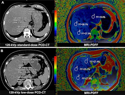 Liver fat content measurement with photon-counting CT and MRI-based proton density fat fraction (PDFF). Three regions of interest (circles) were delineated in the peripheral areas of the left, right anterior, and right posterior lobes of the liver. (A) Representative axial unenhanced 120-kVp standard-dose CT image (left) and corresponding MRI scan (right) in a 33-year-old man (body mass index, 26.2) diagnosed with metabolic dysfunction-associated steatotic liver disease (MASLD) in the asymptomatic cohort. (B) Representative axial unenhanced 120-kVp low-dose CT image (left) and corresponding MRI scan (right) in a 69-year-old woman (body mass index, 24.6) in the MASLD cohort. Body mass index was calculated as weight in kilograms divided by height in meters squared.