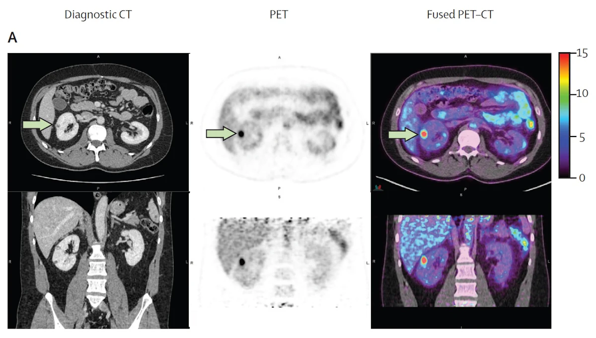 PET_renal_cancer.66e1e00428375
