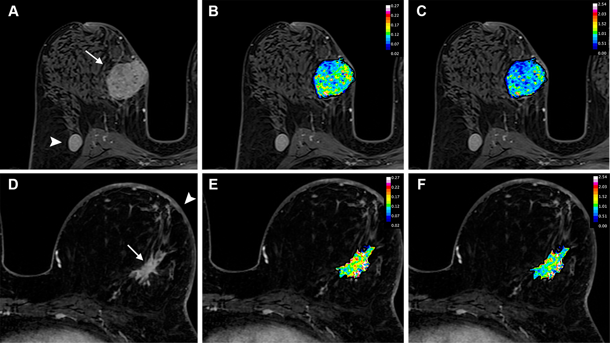 Axial dynamic contrast-enhanced MRI scans show results from two women before they underwent neoadjuvant chemoimmunotherapy for triple-negative breast cancer. (A) T1-enhanced MRI scan, (B) rate constant for contrast agent plasma-to-interstitial transfer (Ktrans) map, and (C) maximum contrast agent uptake rate (Slopemax) map in a 56-year-old woman depict a tumor that manifested as a spherical 4-cm mass enhancement (arrow in A) in the right breast with axillary node involvement (arrowhead in A). The radiomics score was high, at 3.3. Histopathologic examination after chemotherapy revealed no invasive residual cancer in the breast or the lymph nodes (pathologic complete response). (D) T1-enhanced MRI scan, (E) Ktrans map, and (F) Slopemax map in a 49-year-old woman show a tumor that manifested as a spiculated 3-cm mass enhancement (arrow in D) in the left breast with thickening of the skin (arrowhead in D). The parametric maps show much greater spatial heterogeneity than in the case shown in B and C, with areas of high intensity. The radiomics score was low, at &minus;1.6. Histopathologic examination after chemotherapy revealed a 10-mm invasive residual cancer in the breast (not pathologic complete response). Image courtesy of the RSNA.
