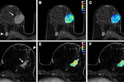 Axial dynamic contrast-enhanced MRI scans show results from two women before they underwent neoadjuvant chemoimmunotherapy for triple-negative breast cancer. (A) T1-enhanced MRI scan, (B) rate constant for contrast agent plasma-to-interstitial transfer (Ktrans) map, and (C) maximum contrast agent uptake rate (Slopemax) map in a 56-year-old woman depict a tumor that manifested as a spherical 4-cm mass enhancement (arrow in A) in the right breast with axillary node involvement (arrowhead in A). The radiomics score was high, at 3.3. Histopathologic examination after chemotherapy revealed no invasive residual cancer in the breast or the lymph nodes (pathologic complete response). (D) T1-enhanced MRI scan, (E) Ktrans map, and (F) Slopemax map in a 49-year-old woman show a tumor that manifested as a spiculated 3-cm mass enhancement (arrow in D) in the left breast with thickening of the skin (arrowhead in D). The parametric maps show much greater spatial heterogeneity than in the case shown in B and C, with areas of high intensity. The radiomics score was low, at −1.6. Histopathologic examination after chemotherapy revealed a 10-mm invasive residual cancer in the breast (not pathologic complete response). Image courtesy of the RSNA.