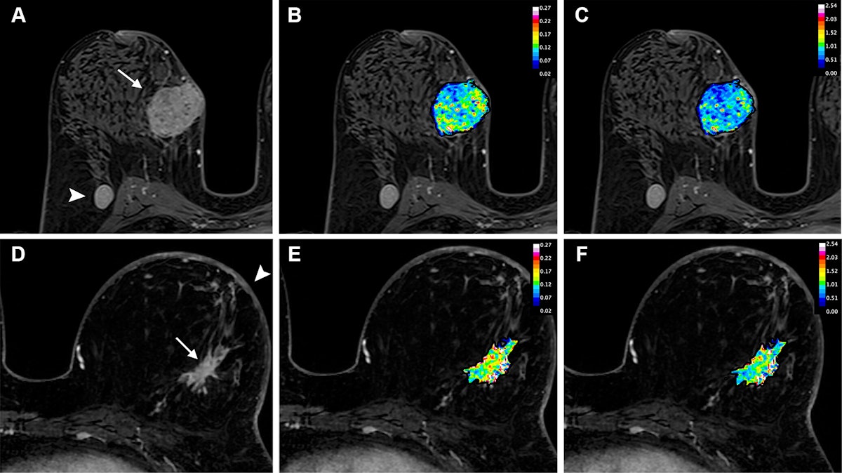 健康・医学 Breast MRI images_large_radiol.240575.