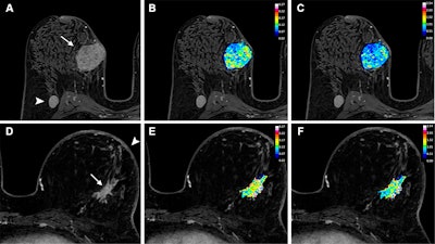 Axial dynamic contrast-enhanced MRI scans show results from two women before they underwent neoadjuvant chemoimmunotherapy for triple-negative breast cancer. (A) T1-enhanced MRI scan, (B) rate constant for contrast agent plasma-to-interstitial transfer (Ktrans) map, and (C) maximum contrast agent uptake rate (Slopemax) map in a 56-year-old woman depict a tumor that manifested as a spherical 4-cm mass enhancement (arrow in A) in the right breast with axillary node involvement (arrowhead in A). The radiomics score was high, at 3.3. Histopathologic examination after chemotherapy revealed no invasive residual cancer in the breast or the lymph nodes (pathologic complete response). (D) T1-enhanced MRI scan, (E) Ktrans map, and (F) Slopemax map in a 49-year-old woman show a tumor that manifested as a spiculated 3-cm mass enhancement (arrow in D) in the left breast with thickening of the skin (arrowhead in D). The parametric maps show much greater spatial heterogeneity than in the case shown in B and C, with areas of high intensity. The radiomics score was low, at −1.6. Histopathologic examination after chemotherapy revealed a 10-mm invasive residual cancer in the breast (not pathologic complete response). Image courtesy of the RSNA.
