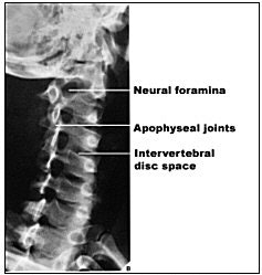Oblique view of the cervical spine. This view is effective primarily for demonstrating neural foramina. Image courtesy of Dr. Naveed Ahmad.