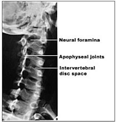 Oblique view of the cervical spine. This view is effective primarily for demonstrating neural foramina. Image courtesy of Dr. Naveed Ahmad.