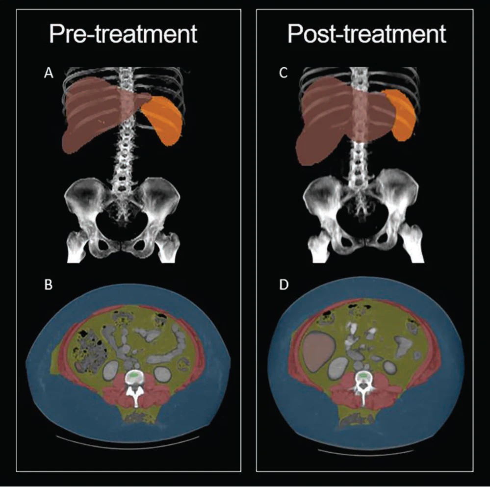 semaglutide bone mineral density Does Ozemic (semaglutide) decrease density? CT shows body composition changes