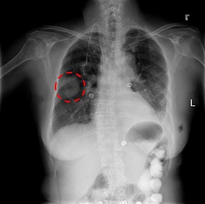 The NIH database includes more than 100,000 chest x-rays. Image courtesy of the NIH.