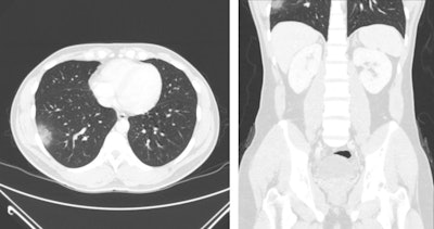 A 33-year-old man presenting with right lower quadrant abdominal pain, found to have acute appendicitis on abdominal/pelvic CT. Axial (left) and coronal (right) views on lung windows demonstrate focal peripheral ground-glass opacity in the right lung base. Images courtesy of the RSNA.