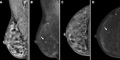 Contrast-enhanced mammography (CEM) images depict a 56-year-old woman with a history of atypical ductal hyperplasia show cancer. Images include the following: screening (A, B) mediolateral oblique views and (C, D) craniocaudal views on (A, C) low-energy images and on (B, D) recombined images in the right breast. At the central slightly outer area in the right breast, mid-depth, there is a new enhancing mass (arrows) with no correlate on low-energy images. Subsequent targeted ultrasound showed a 0.5-cm irregular hypoechoic mass (not shown) for which ultrasound-guided biopsy showed invasive carcinoma, with a 1.2-mm invasive component at surgical pathologic examination and with negative nodes. Image courtesy of the RSNA.
