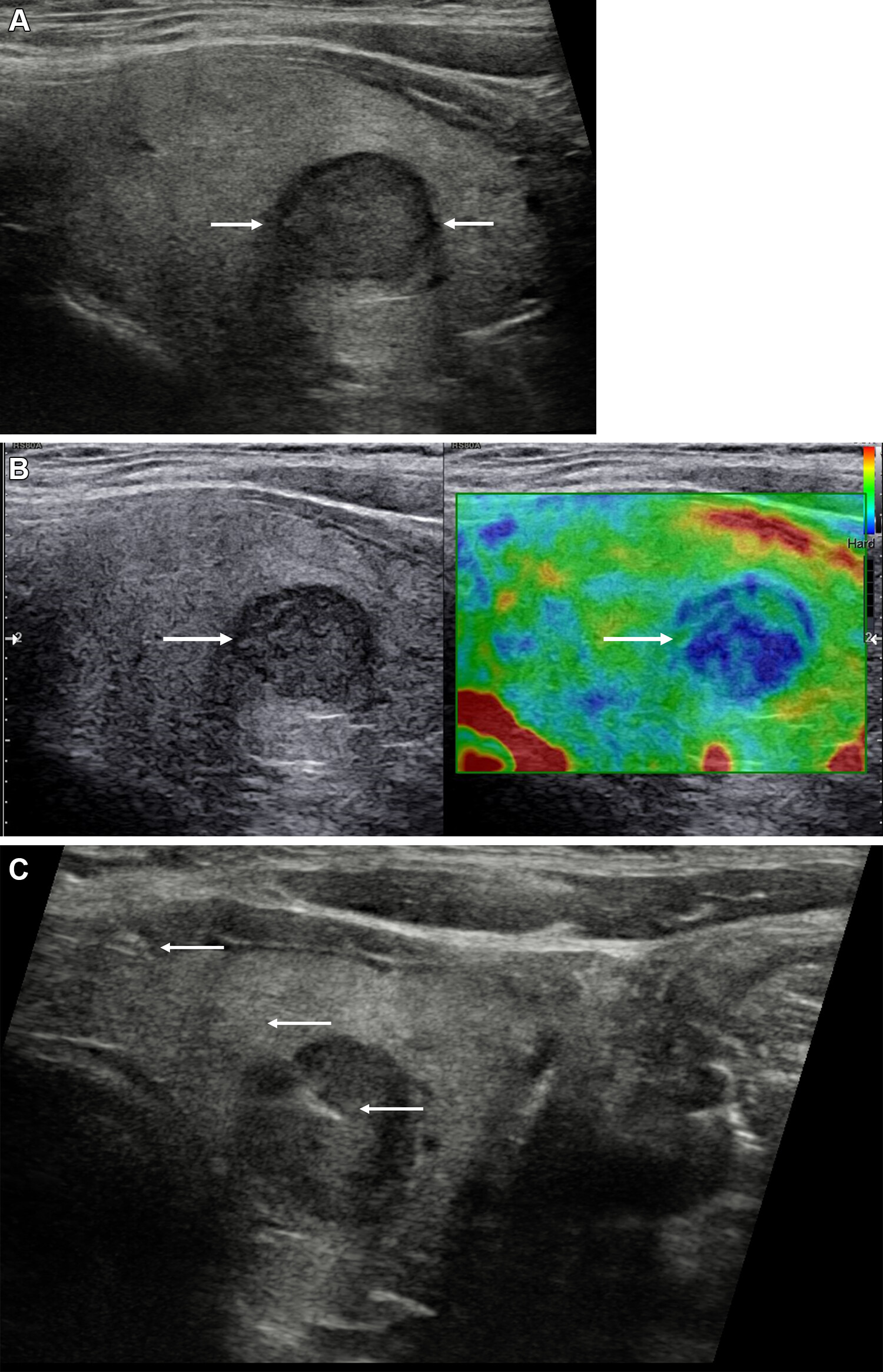 Images depict a 43-year-old woman with a solitary left-sided thyroid nodule classified at gray-scale ultrasound as category U3, upgraded to category U4 at strain elastography, and classified as category Thy4 at cytopathologic examination. Subsequent surgical histopathologic examination confirmed papillary cell carcinoma. (A) Longitudinal view of the left thyroid lobe demonstrates the low reflective nodule (between arrows) measuring 13 &times; 12 &times; 11 mm (not shown) and with a halo. (B) A longitudinal image with side-by-side visualization of the nodule (arrow) at gray scale (left) and strain elastography (right). The nodule is predominantly blue, indicating increased stiffness. (C) A longitudinal view shows the needle (arrows) within the stiffer aspect of the nodule for cytology sampling. U and Thy categories are according to British Thyroid Association system. Image courtesy of the RSNA.