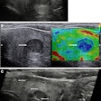 Images depict a 43-year-old woman with a solitary left-sided thyroid nodule classified at gray-scale ultrasound as category U3, upgraded to category U4 at strain elastography, and classified as category Thy4 at cytopathologic examination. Subsequent surgical histopathologic examination confirmed papillary cell carcinoma. (A) Longitudinal view of the left thyroid lobe demonstrates the low reflective nodule (between arrows) measuring 13 × 12 × 11 mm (not shown) and with a halo. (B) A longitudinal image with side-by-side visualization of the nodule (arrow) at gray scale (left) and strain elastography (right). The nodule is predominantly blue, indicating increased stiffness. (C) A longitudinal view shows the needle (arrows) within the stiffer aspect of the nodule for cytology sampling. U and Thy categories are according to British Thyroid Association system. Image courtesy of the RSNA.