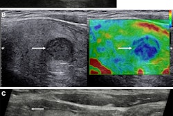 Images depict a 43-year-old woman with a solitary left-sided thyroid nodule classified at gray-scale ultrasound as category U3, upgraded to category U4 at strain elastography, and classified as category Thy4 at cytopathologic examination. Subsequent surgical histopathologic examination confirmed papillary cell carcinoma. (A) Longitudinal view of the left thyroid lobe demonstrates the low reflective nodule (between arrows) measuring 13 × 12 × 11 mm (not shown) and with a halo. (B) A longitudinal image with side-by-side visualization of the nodule (arrow) at gray scale (left) and strain elastography (right). The nodule is predominantly blue, indicating increased stiffness. (C) A longitudinal view shows the needle (arrows) within the stiffer aspect of the nodule for cytology sampling. U and Thy categories are according to British Thyroid Association system. Image courtesy of the RSNA.