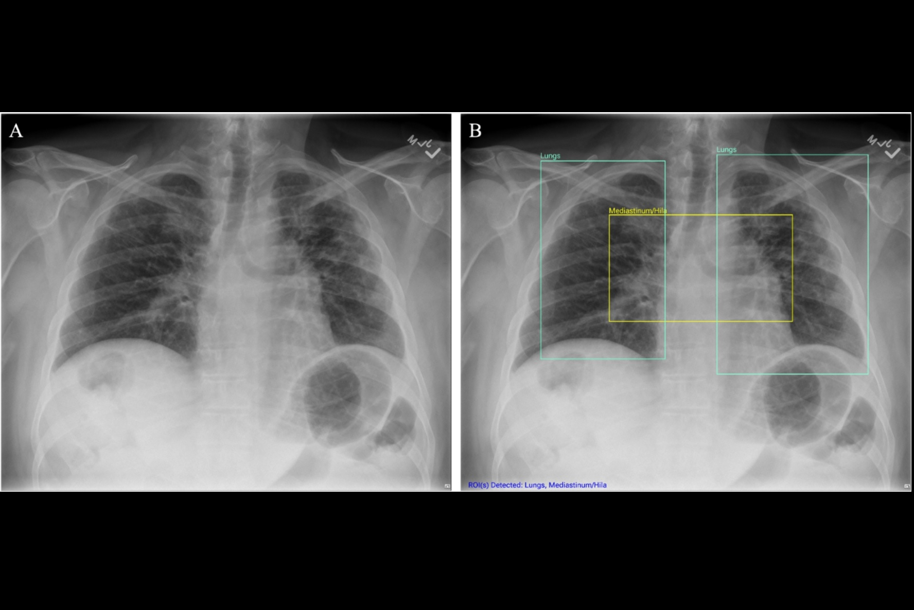 2024 10 25 Chest Cad Thumbnail