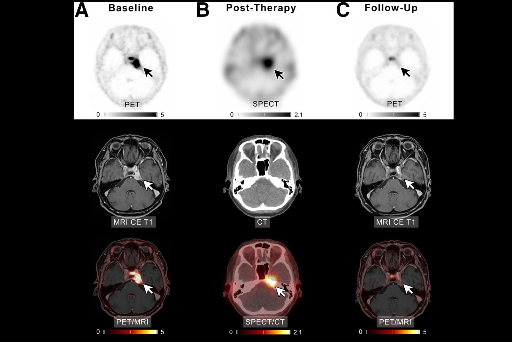 2024 10 28 Meningioma Thumbnail