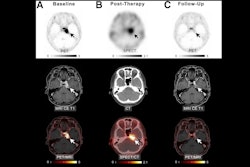 2024 10 28 Meningioma Thumbnail