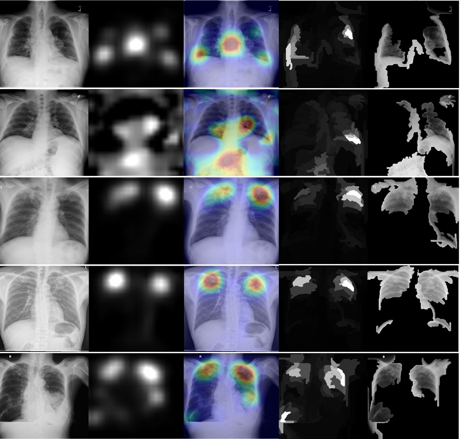 XRAI (left) and GradCAM (right) heatmaps for true positive images. The original radiographs are on the left, the Grad-CAM activations and heatmaps are in the middle, and the XRAI activations and overlays are on the right. For the XRAI overlays, only regions reaching the 70th percentile of activation strength are shown. Images available under Creative Commons license (CC BY 4.0 DEED, Attribution 4.0 International) and courtesy of PLOS Digital Health.