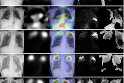 XRAI (left) and GradCAM (right) heatmaps for true positive images. The original radiographs are on the left, the Grad-CAM activations and heatmaps are in the middle, and the XRAI activations and overlays are on the right. For the XRAI overlays, only regions reaching the 70th percentile of activation strength are shown. Images available under Creative Commons license (CC BY 4.0 DEED, Attribution 4.0 International) and courtesy of PLOS Digital Health.