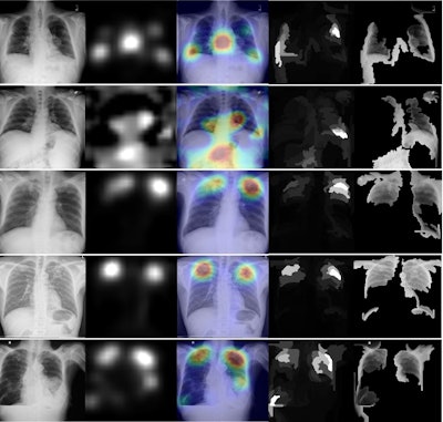XRAI (left) and GradCAM (right) heatmaps for true positive images. The original radiographs are on the left, the Grad-CAM activations and heatmaps are in the middle, and the XRAI activations and overlays are on the right. For the XRAI overlays, only regions reaching the 70th percentile of activation strength are shown. Images available under Creative Commons license (CC BY 4.0 DEED, Attribution 4.0 International) and courtesy of PLOS Digital Health.