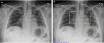 (A) Chest x-ray unaided by the AI system. (B) Chest x-ray aided by the AI system shows two Lung ROIs (green boxes) and a Mediastinum/Hila ROI (yellow box). The AI system identified abnormalities that were characterized as regions of interest in Lungs and Mediastinum/Hila. The abnormalities were bilateral upper lobe pulmonary fibrosis (categorized as ‘Lungs’), and pulmonary artery hypertension along with bilateral hilar retraction (categorized as ‘Mediastinum/Hila’). The ROIs for each category are illustrated in different colors for readability.