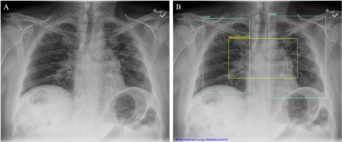 AI lifts nonradiologists' x-ray interpretation skill levels