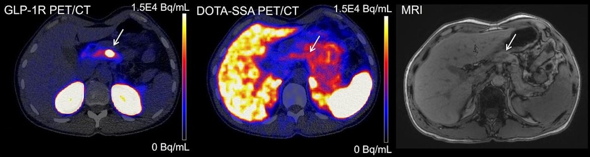 公式の  detection improves tracer PET New of AuntMinnie | insulinomas スノーボード