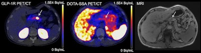 Images of exendin PET/CT, DOTA-SSA-PET/CT, and CE-DWI-MRI (T1-weighted precontrast) of a study participant. Location of insulinoma in pancreas body is indicated with arrows. Only exendin PET/CT was true positive in this patient.