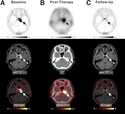 A patient with meningioma of unknown grade undergoing intraarterial PRRT with Lu-177 DOTATATE. (A) Transaxial slices of baseline PET, contrast-enhanced (CE) T1-weighted MRI, and fused PET/MRI demonstrate SSTR-expressing meningioma in left cavernous sinus (white and black arrows). After four cycles of PRRT (posttherapeutic SPECT/CT imaging after the first cycle presented in B), complete remission was recorded (C). In line with imaging, patient reported significant improvement of previous vertigo, headaches, and isolated unilateral abducens nerve palsy. Scale bars denote standard uptake values.