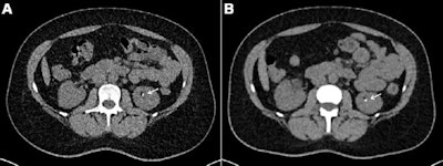 Axial contrast-unenhanced abdominal CT examinations in a 38-year-old female patient with a body mass index (calculated as weight in kilograms divided by height in meters squared) of 31.23 with known renal calculi for recurring events of flank pain. The patient underwent (A) dose-optimized energy-integrating detector CT (1.49 mSv) and (B) submillisievert photon-counting detector CT (0.94 mSv). Images from both examinations showed a 3-mm calculus in the left kidney (arrows). Image and caption courtesy of the RSNA.