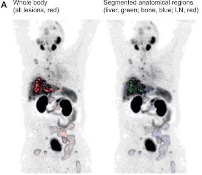 Whole-body anterior coronal PSMA-PET maximum intensity projection images in a 63-year-old white male participant with tumors in the liver, bone, and lymph node (LN) who had an initial prostate-specific antigen level of 181.9 ng/mL and Eastern Cooperative Oncology Group performance score of 0/1. The images show all PSMA-positive (PSMA+) disease as a single whole-body volume in red (left) and segmented according to anatomic region (right; bone lesions in blue, liver lesions in green, lymph node lesions in red). Image courtesy of RSNA.