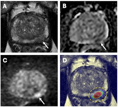 67-year-old male with a serum PSA of 6.5ng.ml. Axial T2W MRI (A) shows a hypointense lesion in the left apical-mid peripheral zone (arrow) which demonstrates focal diffusion restriction on ADC map (B) and high b-value diffusion-weighted MRI (C) (arrows). AI output of a biparametric prostate MRI lesion detection AI model demonstrates high cancer probability within the left apical-mid peripheral zone lesion (dashed yellow circle) (D). MRI/TRUS fusion guided biopsy revealed Gleason 3+4 prostate cancer within this lesion. Images and caption courtesy of the National Cancer Institute.