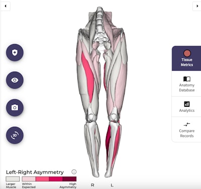 Springbok's interactive viewer can show, muscle symmetry, for example from analysis of MRI exams. Image courtesy of Springbok Analytics.