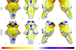 3D projections of the QSM χ maps on the rendered brainstem ROI extracted from the FreeSurfer segmentation for the healthy control group and the COVID group. The COVID group shows increased χ in the brainstem, specifically in the medulla and pons (black arrows). Images courtesy of the University of Cambridge.