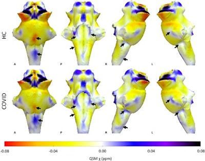 3D projections of the QSM χ maps on the rendered brainstem ROI extracted from the FreeSurfer segmentation for the healthy control group and the COVID group. The COVID group shows increased χ in the brainstem, specifically in the medulla and pons (black arrows). Images courtesy of the University of Cambridge.