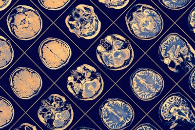 Mri Brain