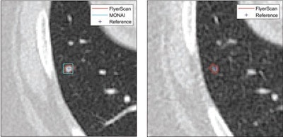 12-year-old male patient who underwent chest CT due to hepatocellular carcinoma. Cropped axial CT images in pediatric patient showing CAD results operating at mean of two false positives per scan for both standard-dose and low-dose scans. Red contours represent FlyerScan CAD system detections. Cyan boxes represent MONAI CAD system detections. Blue '+' symbols represent annotated nodule center-of-mass coordinates, determining reference standard. (Left) Standard-dose image (1.39 mSv). Both CAD systems identified nodule. (Right) Low-dose image (0.34 mSv). Nodule was identified by FlyerScan but missed by MONAI. Images and caption courtesy of the AJR.