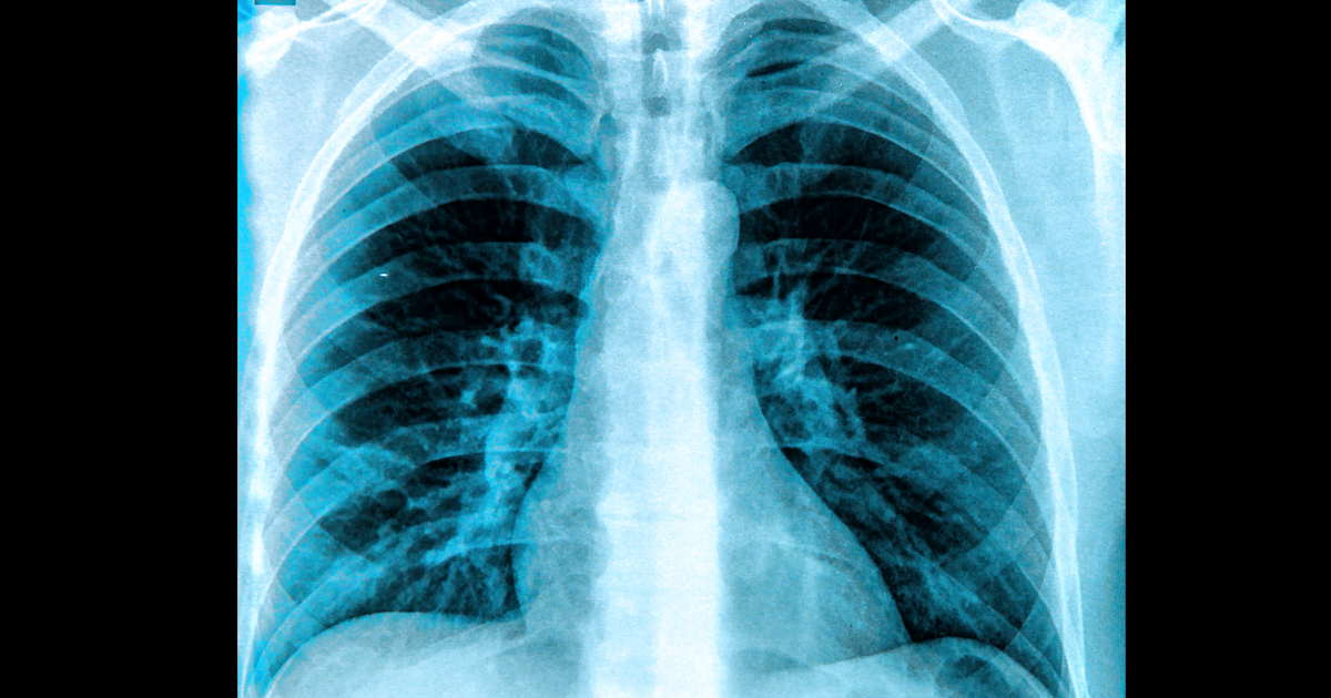 X Ray Chest Lungs Social