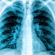 X Ray Chest Lungs Social