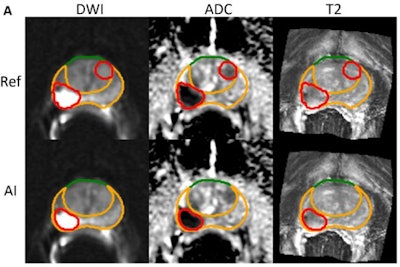 AI-derived tumor volume at mpMRI and outcomes in localized prostate cancer. Image courtesy of Radiology.