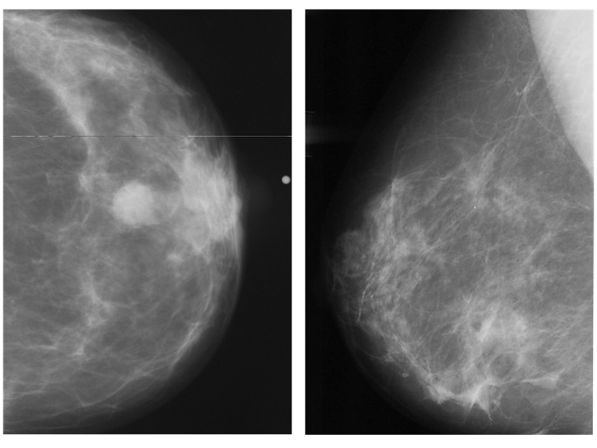 Abnormal mammogram (left) compared with normal mammogram. Image courtesy of the RSNA.