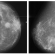 Abnormal mammogram (left) compared with normal mammogram. Image courtesy of the RSNA.