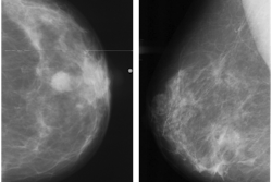 Abnormal mammogram (left) compared with normal mammogram. Image courtesy of the RSNA.