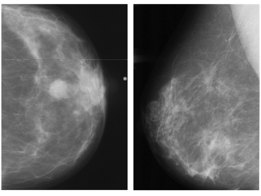 Normal V Abnormal Mammogram Illustrative Case Reports | Radiology Key