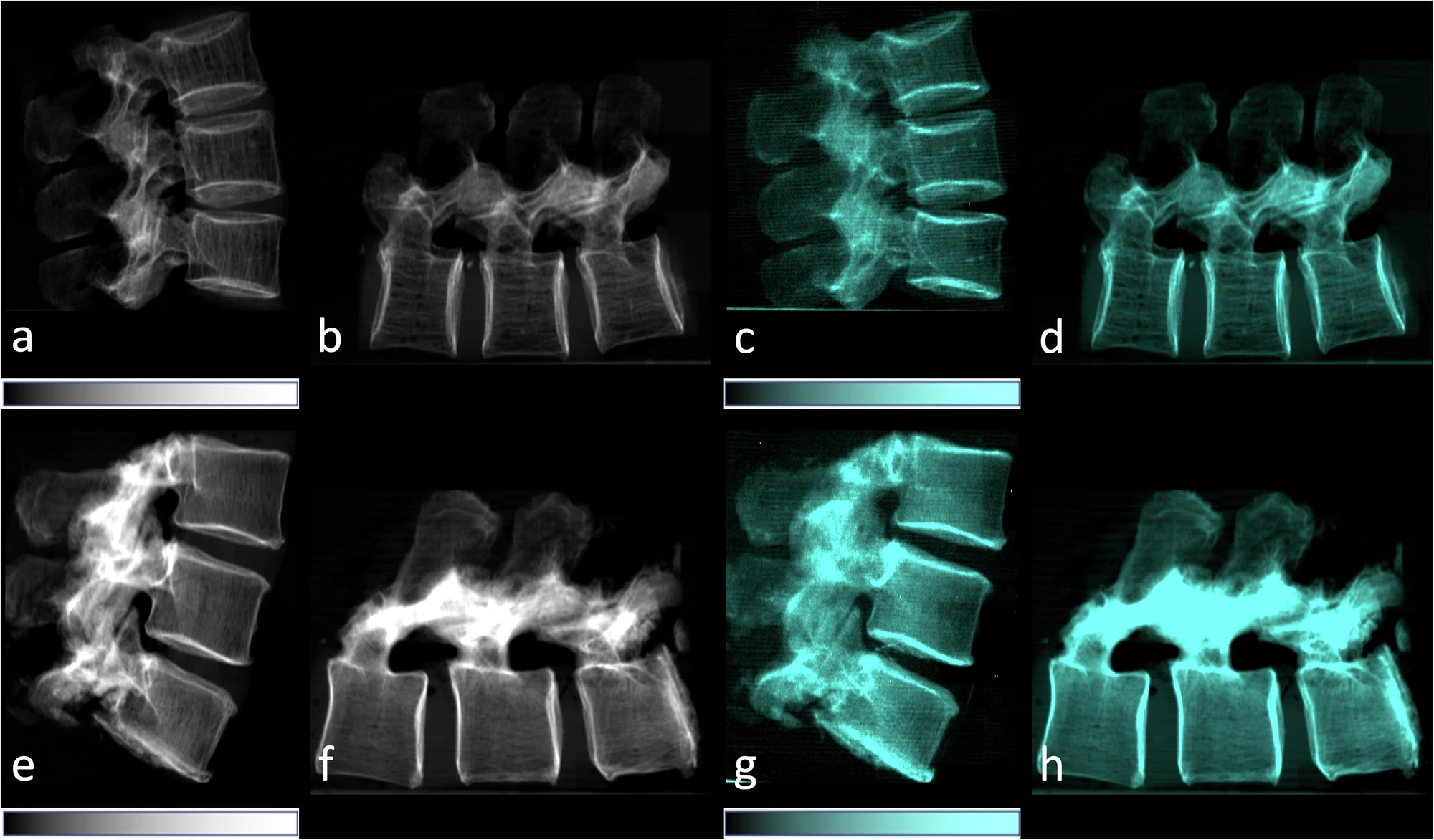Lateral conventional attenuation (a, b, e, f) and co-registered dark-field (c, d, g, h) images of two spine specimens. Vertical (a, c, e, g) and horizontal (b, d, f, h) scans of the spine specimen of a 77-year-old female with osteoporosis (bone mineral density = 65.75 mg/dL) (a&ndash;d) and a non-osteoporotic spine specimen (e&ndash;h) of a 61-year-old female (bone mineral density = 169.38 mg/dL).