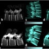 Lateral conventional attenuation (a, b, e, f) and co-registered dark-field (c, d, g, h) images of two spine specimens. Vertical (a, c, e, g) and horizontal (b, d, f, h) scans of the spine specimen of a 77-year-old female with osteoporosis (bone mineral density = 65.75 mg/dL) (a–d) and a non-osteoporotic spine specimen (e–h) of a 61-year-old female (bone mineral density = 169.38 mg/dL).